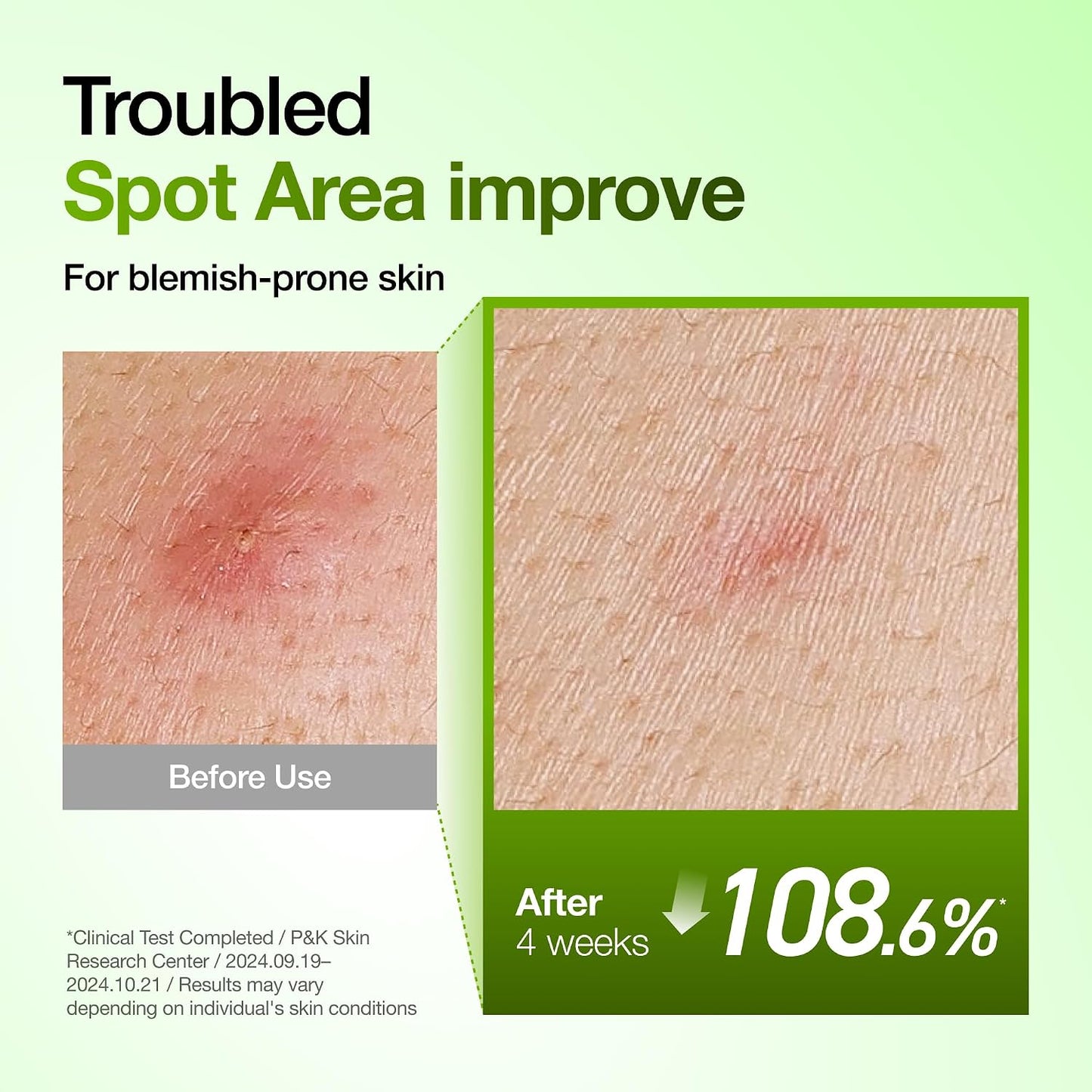 Anua Azelaic Acid 10% Redness Relief Serum – Calm, Clear & Hydrated Skin (30ml)